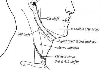 pharyngeal_groove_disease.jpg