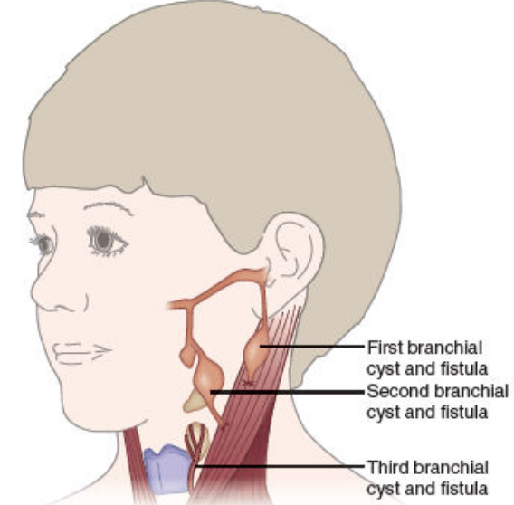 branchial_cleft_cyst_fistula.PNG