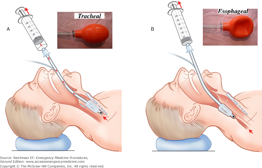 Esophageal_detector_device.png