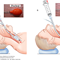 Esophageal_detector_device.png