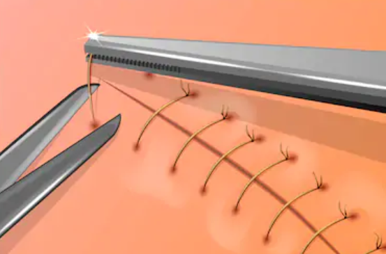 suture_in_ER.PNG suture_in_ER.PNG