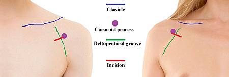 incision suggestion.jpg