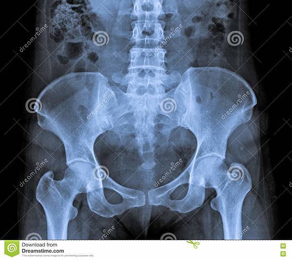 x-ray-abdomen-pelvic-patient-bone-vertebra-74661384