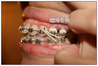 人字拖小姮牙套歲月 橡皮筋酷刑 人字拖小姮隨便寫 痞客邦