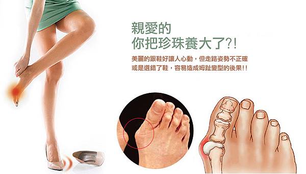 親愛的 你把珍珠養大了 姆趾外翻 台灣足鞋健康協會 足部知識小學堂 痞客邦 親愛的 你把珍珠養大了 姆趾外翻 台灣足鞋健康協會 足部知識小學堂 痞客邦