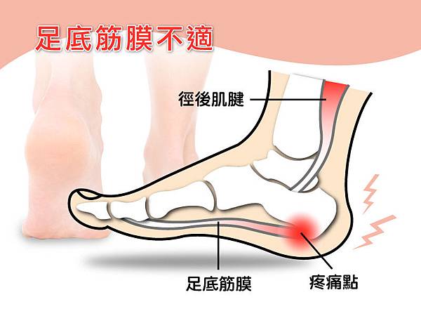 腳底痛到像針扎 小心 足底筋膜炎 台灣足鞋健康協會 足部知識小學堂 痞客邦 腳底痛到像針扎 小心 足底筋膜炎 台灣足鞋健康協會 足部知識小學堂 痞客邦