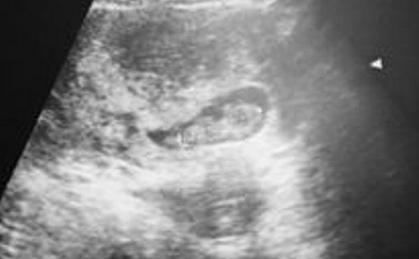懷孕初期.PNG