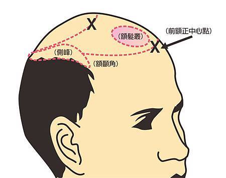 植髮髮線規劃-2.jpg