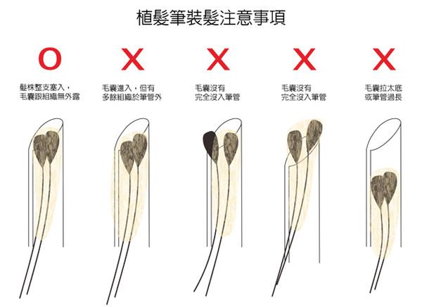 植髮筆裝髮_注意事項.jpg