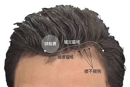 植髮髮線規劃-3.jpg
