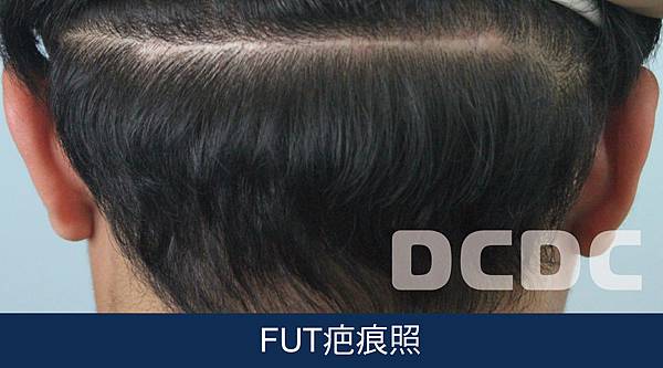 植髮案例 頭髮越變越細 雄性禿的前兆 黃于甄醫師案例 Dcdc植髮醫美整型團隊 植髮案例 頭髮越變越細 雄性禿的前兆 黃于甄醫師案例 Dcdc植髮醫美整型團隊