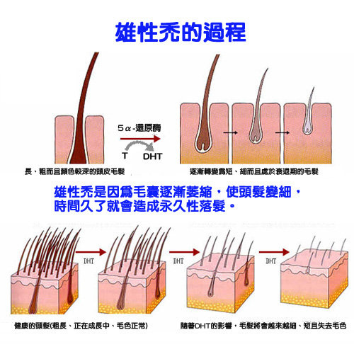 雄性秃.jpg