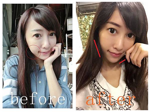 星和桃園_基因檢測+極線音波拉提23 星和桃園_基因檢測+極線音波拉提23