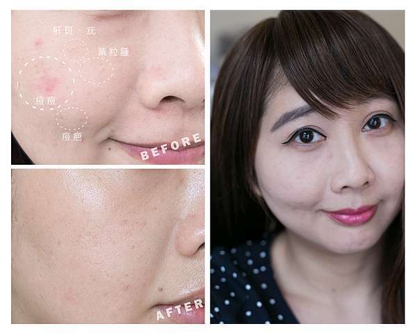 皮秒雷射 凹洞痘疤 凸痘疤令人困擾 痘疤治療是一件困難的事 皮秒雷射治療痘疤是最新最佳的痘疤治療方法 痘疤治療診所推 Flickr