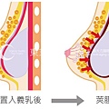 義乳置入乳房層次很重要