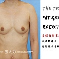 002-fat grafted breast case1.jpg