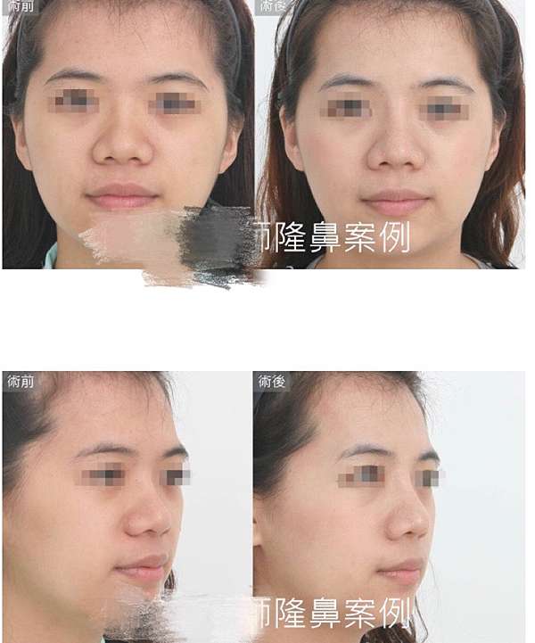 隆鼻分享諮詢篇 想了年的隆鼻之三段式隆鼻手術前 此為隆鼻二次重修整形事前諮詢之玻尿酸補淚溝篇 上集