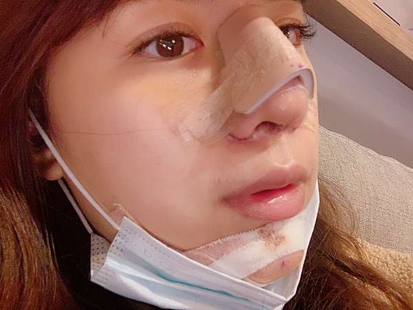 隆鼻手術當天 兩個月分享 想了年的隆鼻下集決定美麗新診所林鴻穎醫生 手術當天 二次隆鼻重修 墊下巴 21隆鼻後更新照片 隆鼻手術當天 兩個月分享 想了年的隆鼻下集決定美麗新診所林鴻穎醫生 手術當天 二次隆鼻重修 墊下巴 21隆鼻後更新照片
