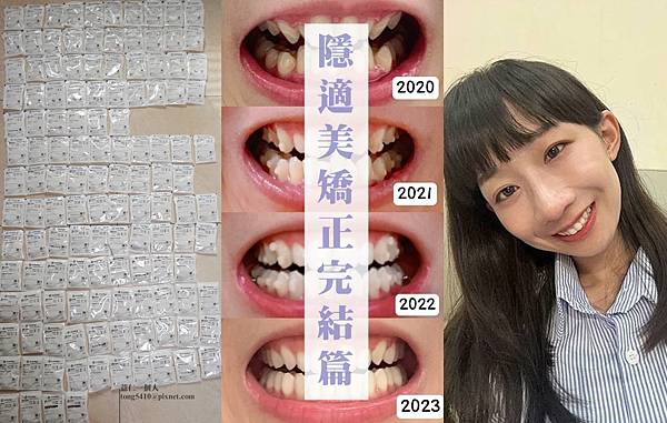 ☀隱適美矯正日記完結篇☀我總算矯正完成啦! 前後對比超有感。