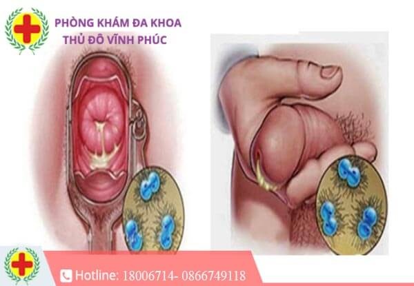 bệnh lậu là gì?