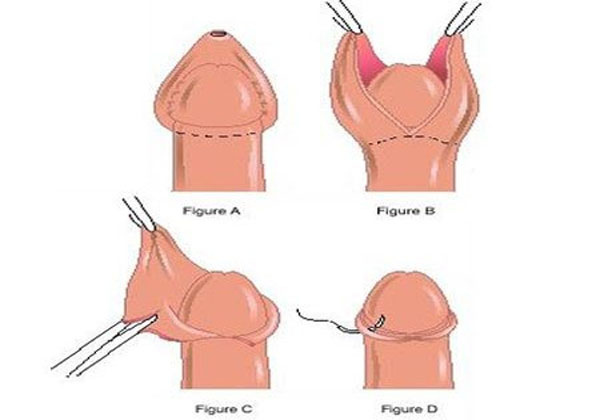 quy-trinh-cat-hep-bao-quy-dau.jpg quy-trinh-cat-hep-bao-quy-dau.jpg