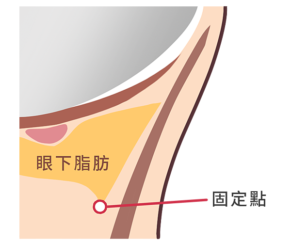 1.無痕內開眼袋3-2.png