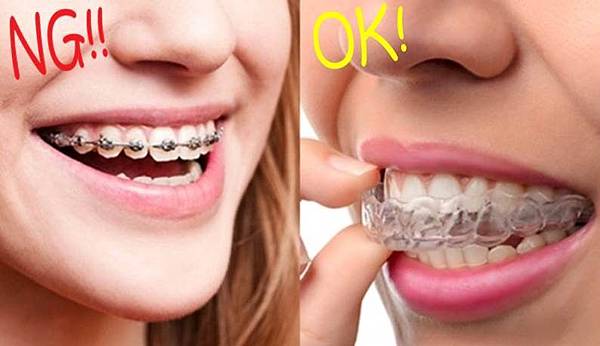 brackets-vs-invisalign-1504120716-9978.jpg