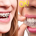 brackets-vs-invisalign-1504120716-9978.jpg