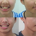 invisalign-1.jpg