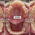 brackets-vs-invisalign-1504120716-9977.jpg