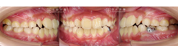 2(矯正前).png 2(矯正前).png