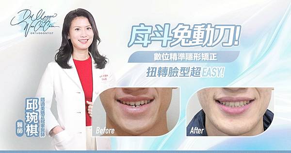 不需手術！數位精準隱形矯正 如何改善戽斗及臉型？