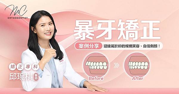 暴牙掰掰！ 迎接屬於妳的燦爛笑容、自信側顏！