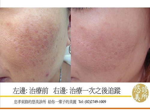 F-Ray膚質檢測儀