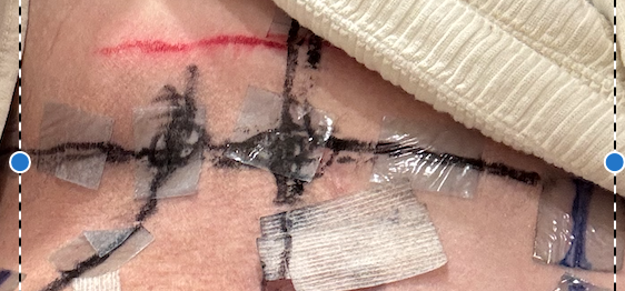 【肉瘤不要鬧】靈魂療癒 × 放射治療：我與身體的重啟對話｜惡