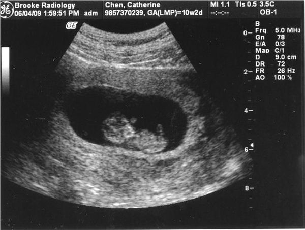 1st ultrasound