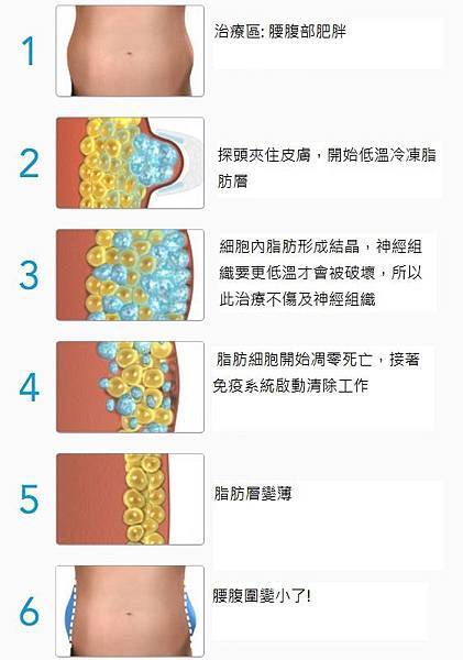 how-coolsculpting-works