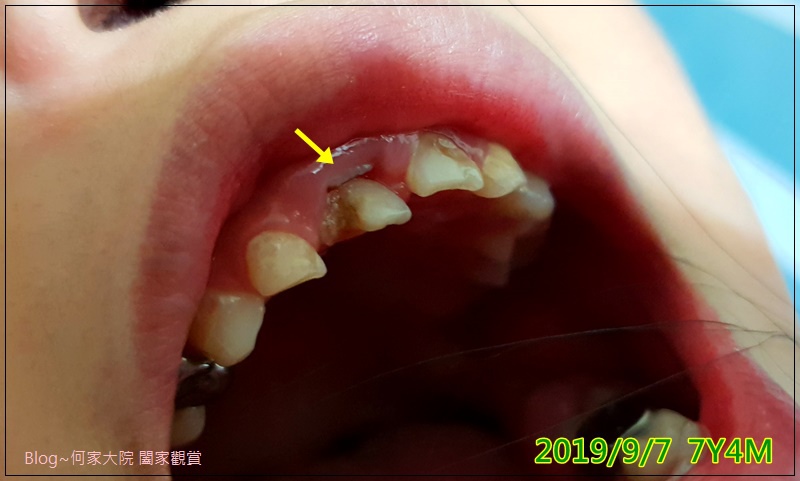 何小妹換牙記 20190908-1.jpg