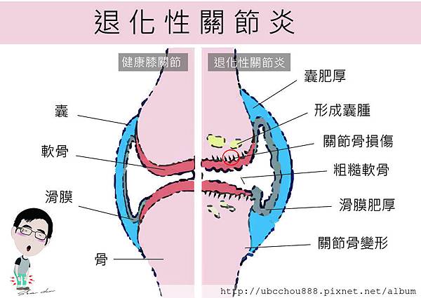 LA20 關節炎-01.jpg