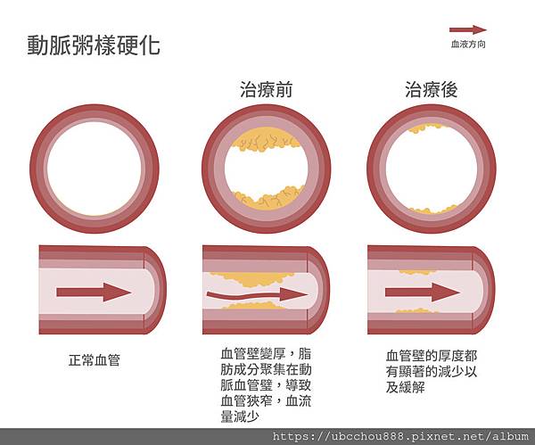 動脈硬化-01.jpg