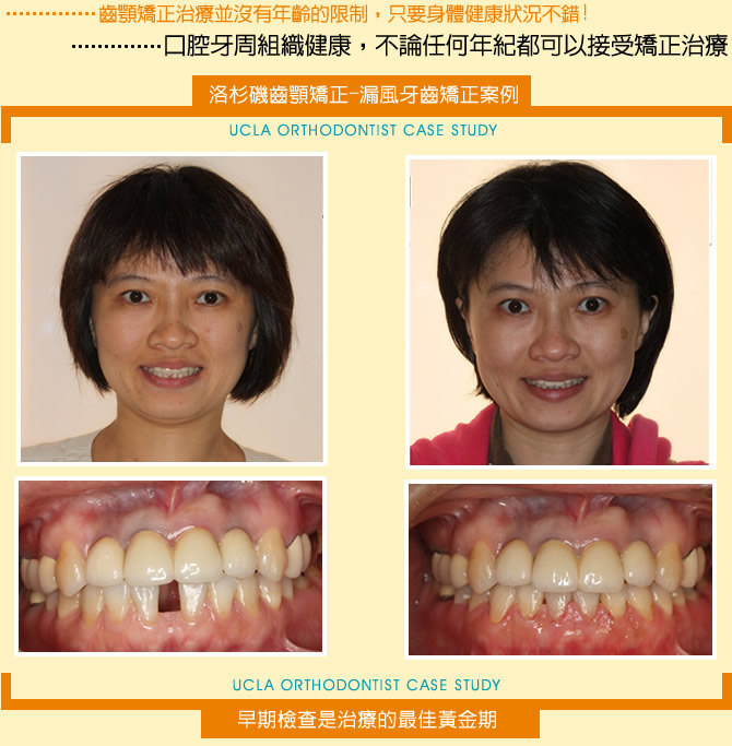 牙齒矯正-漏風牙齒矯正案例分享(一)
