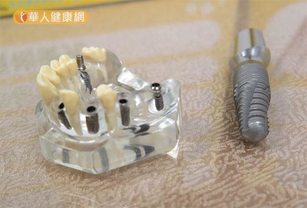 植牙後一勞永逸?牢記7照護重點((新聞分享)) 植牙後一勞永逸?牢記7照護重點((新聞分享))