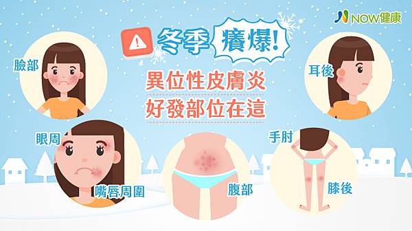 (焦點輪播)圖片：異位性皮膚炎盛行於冬季 尤其這幾個部位特別容易發作