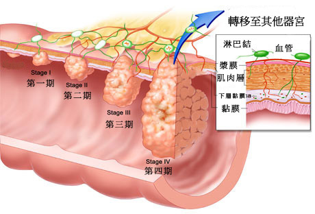 腸癌分期.tif