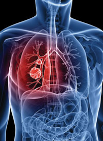 1. Lung cancer.tif