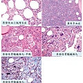 MPN pathology.tif