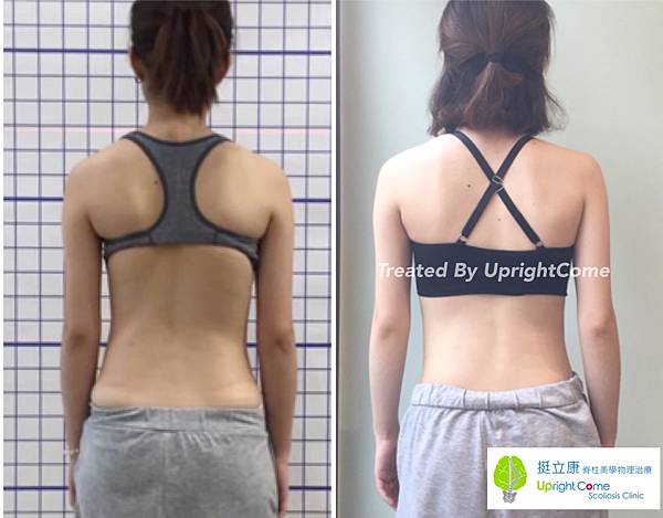 挺立康脊椎側彎治療.jpg 挺立康脊椎側彎治療.jpg