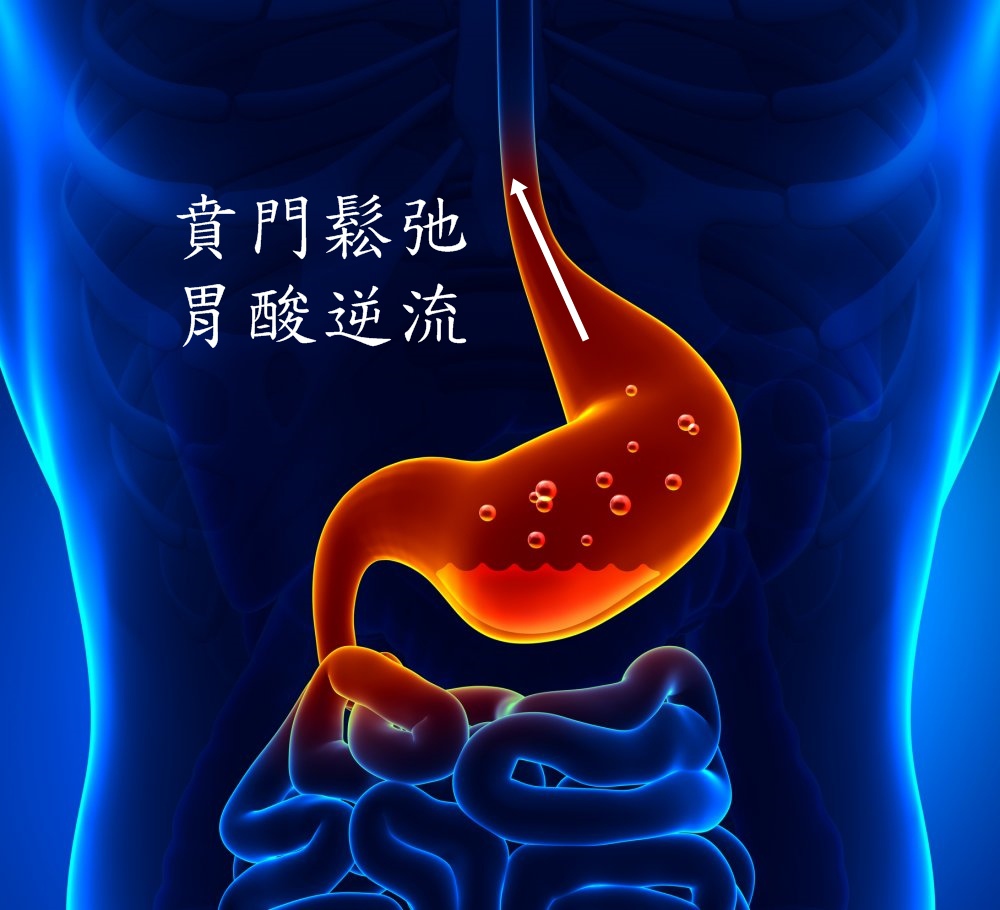 胃食道逆流示意.jpg