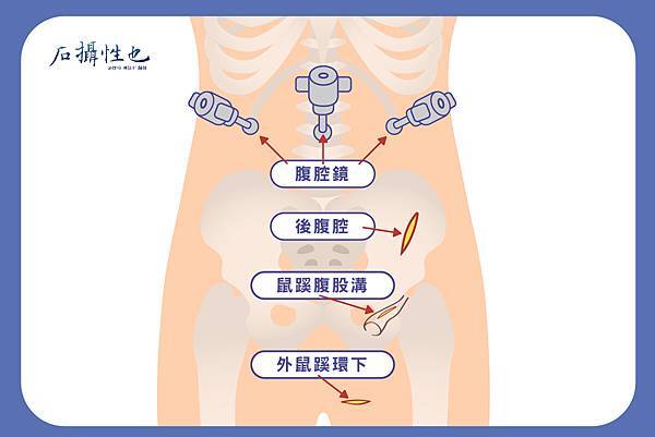 精索靜脈曲張系列2-02