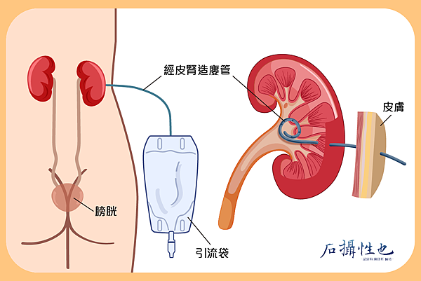 經皮腎造廔管-03